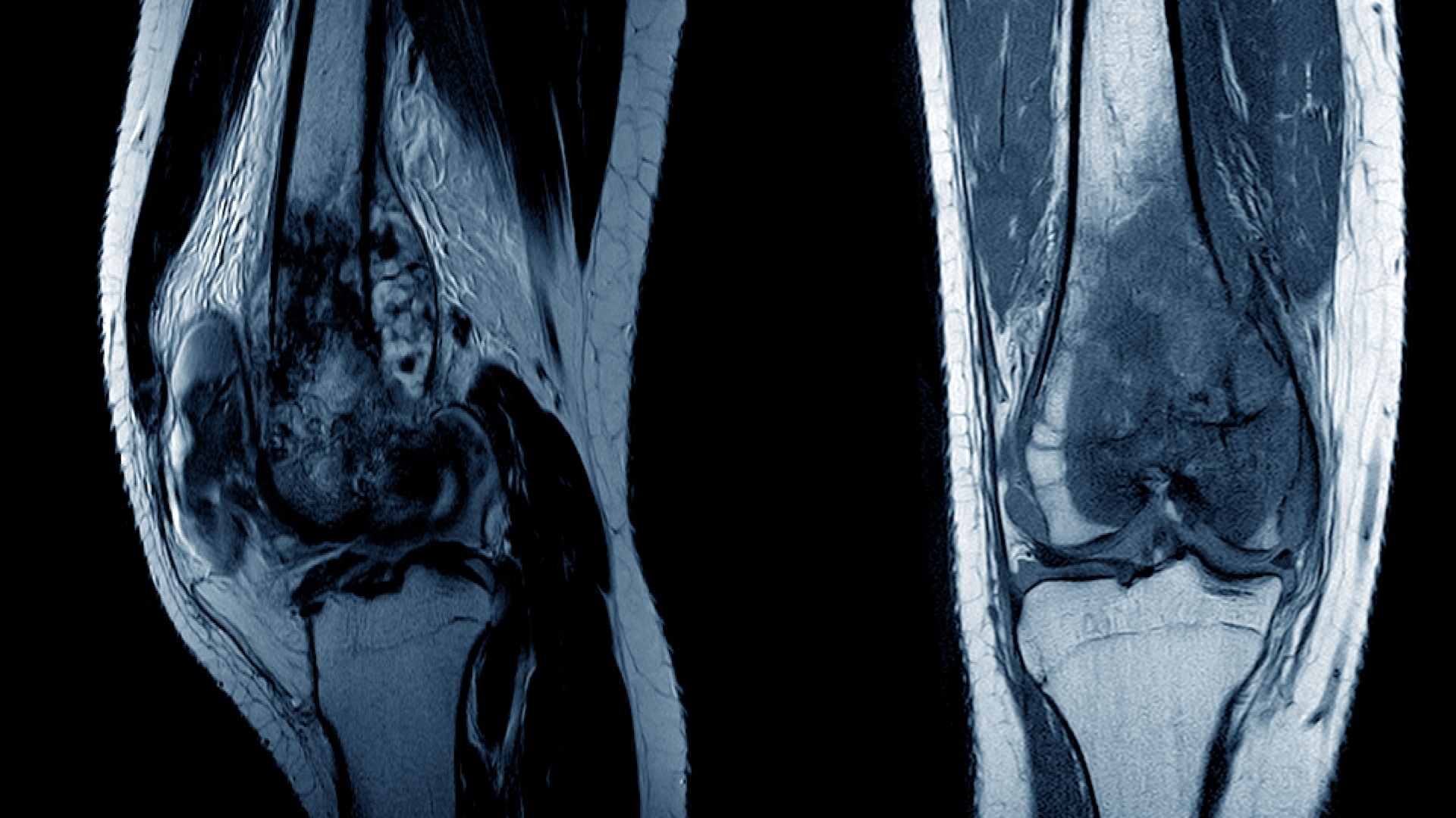 Osteosarkoma Gejala dan Penyebabnya