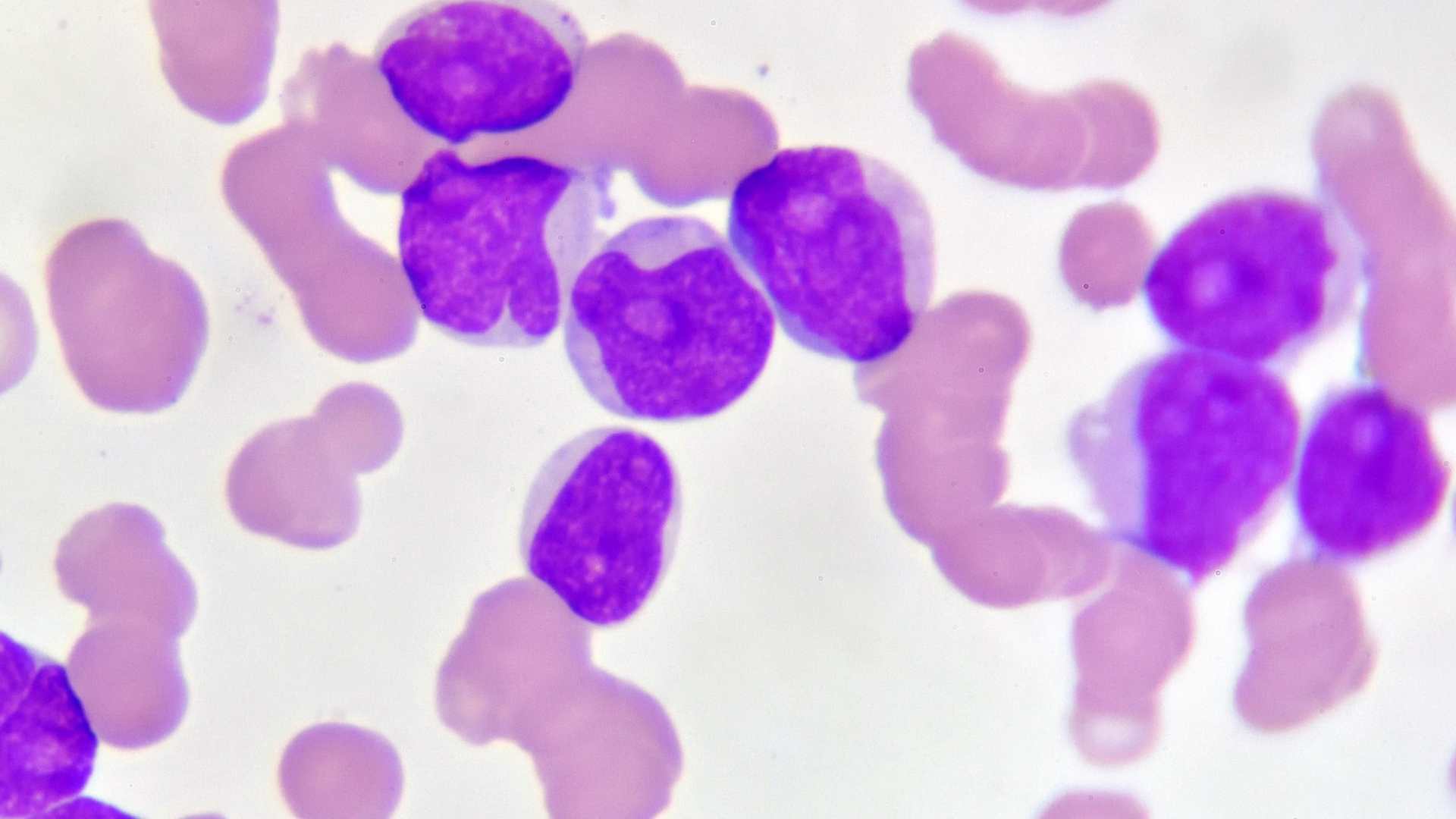Apakah Leukemia Bisa Disembuhkan