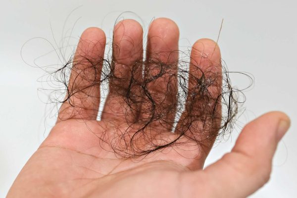 Alopecia Areata adalah Kebotakan