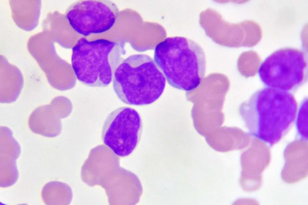 Apakah Leukemia Bisa Disembuhkan