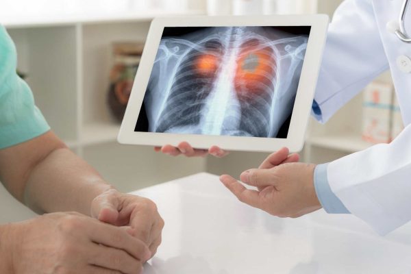 Apakah Pasien dengan Kanker Paru Bisa Sembuh