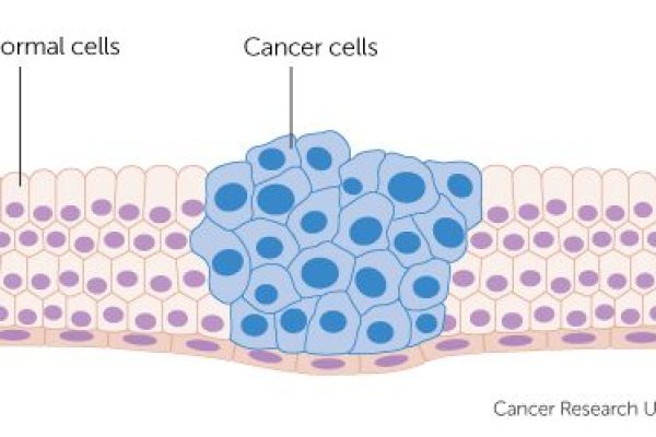 Kenali Tahapan Terjadinya Kanker (Karsinogenesis) dan Resiko Penyebab Kanker Sejak Dini